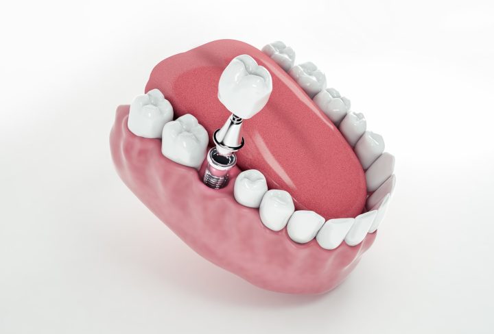 Dental Crown Procedure